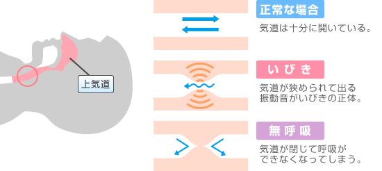 いびきとは？