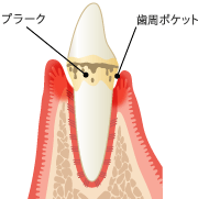 歯肉炎