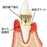 歯周炎