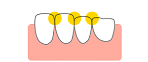 歯と歯の間