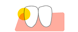 歯と歯肉の境目