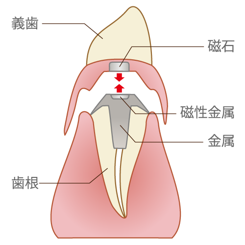 マグフィット（磁石式入れ歯）